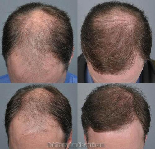 Hair transplantation surgery before and after photos