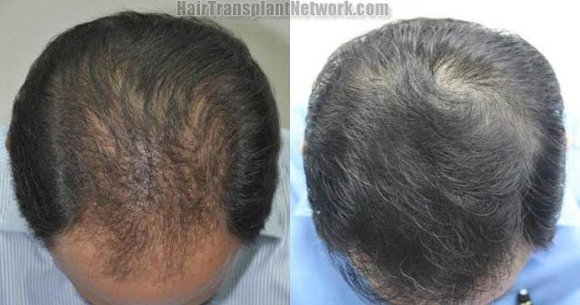 Hair transplantation surgery before and after photos