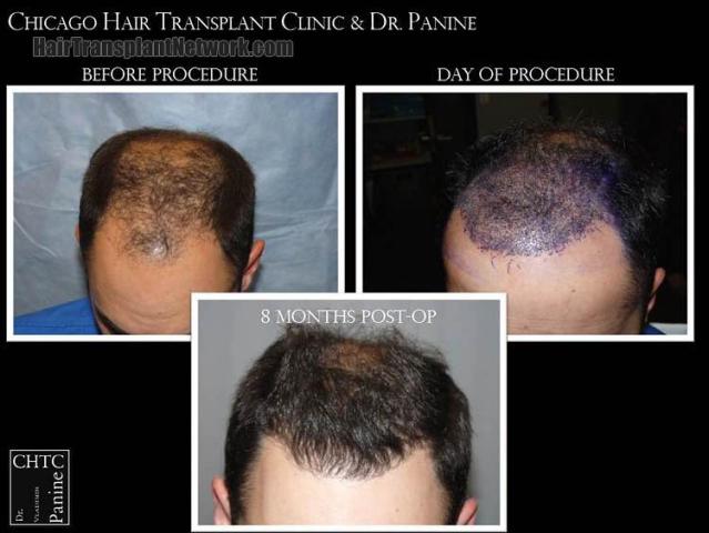 Hair transplantation surgery before and after photos