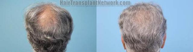 Hair transplantation surgery before and after pictures