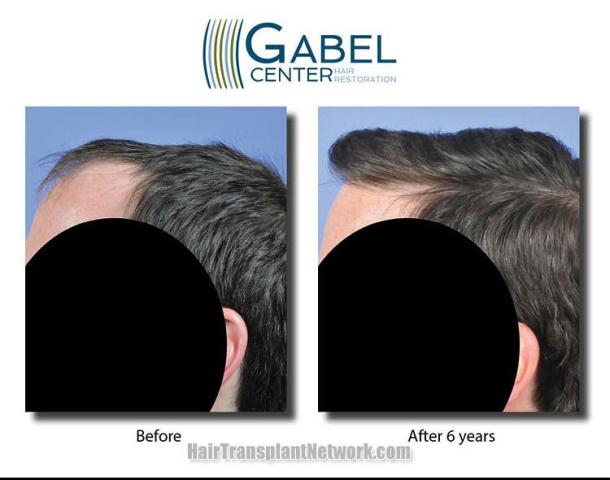 Hair transplantation surgery before and after images