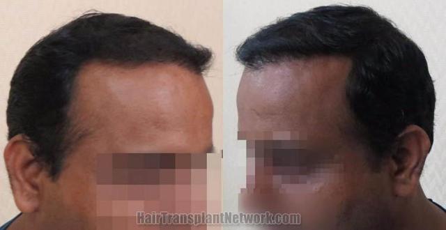 Hair transplantation surgery before and after images