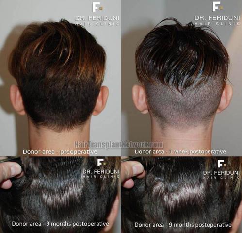 Hair transplantation surgery before and after pictures