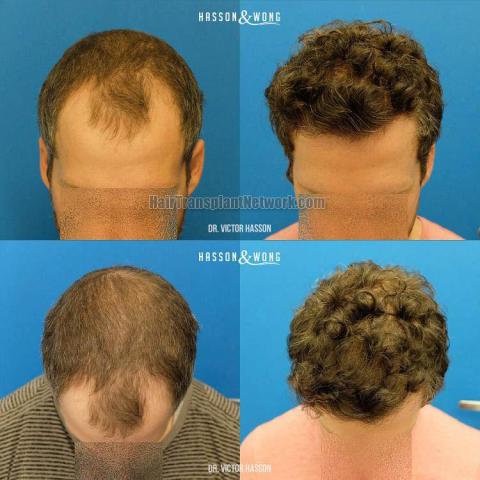 Hair transplantation surgery before and after photos