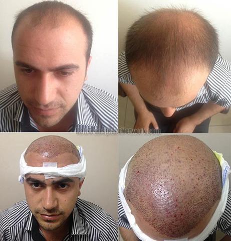 Hair restoration procedure before and after result photographs