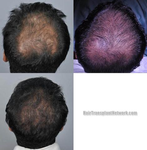 Hair transplantation surgery before and after pictures