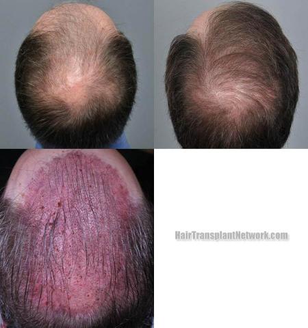 Hair transplantation surgery before and after pictures