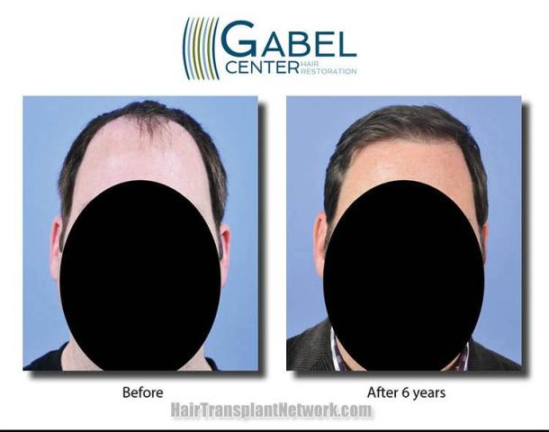 Hair restoration procedure before and after results