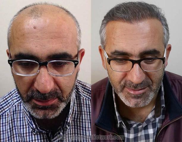 Before and after hair transplant procedure images