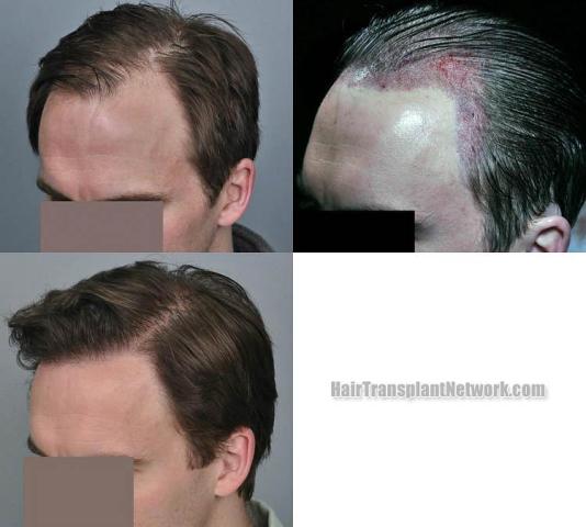 Hair restoration procedure before and after pictures