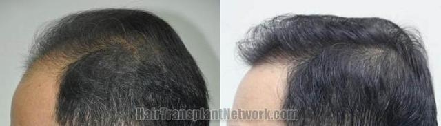 Hair transplantation surgery before and after pictures