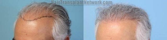 Hair transplantation surgery before and after images