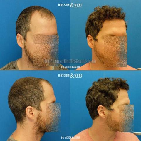 Hair transplantation surgery before and after images