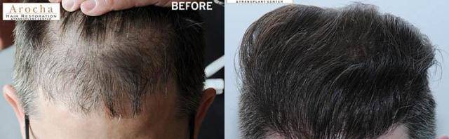 Hair transplantation surgery before and after photos