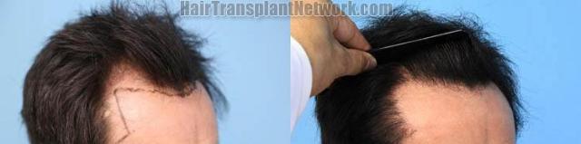 Hair transplantation surgery before and after images