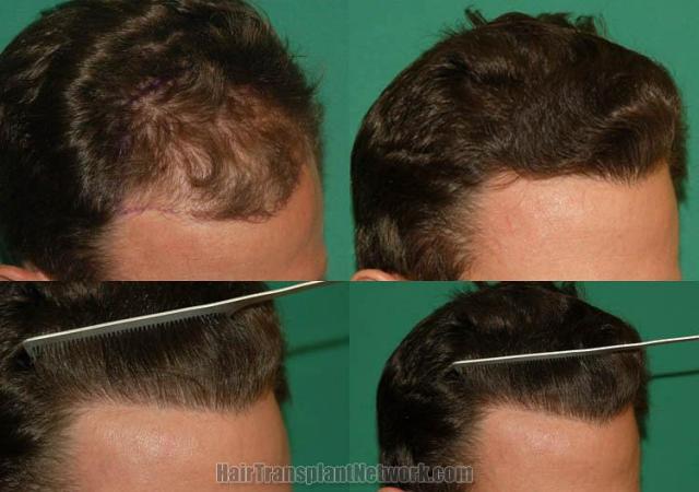 Hair transplantation surgery before and after images