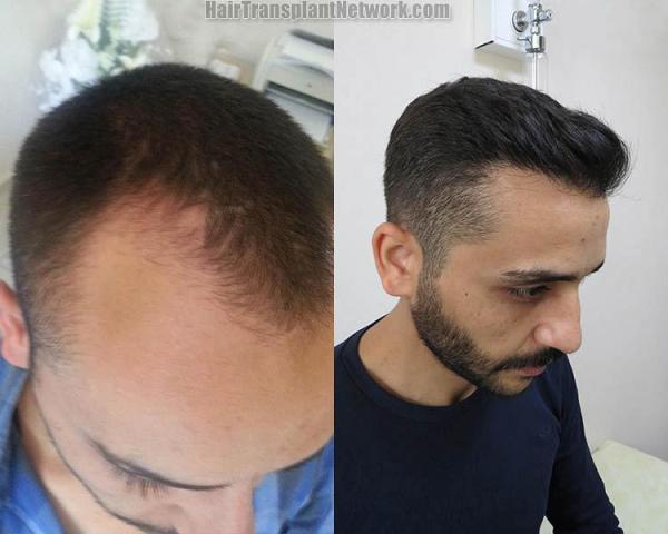 Hair transplantation surgery before and after photos