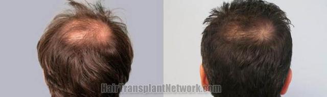 Hair restoration procedure before and after pictures