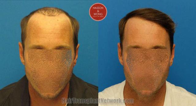 Hair restoration procedure before and after results