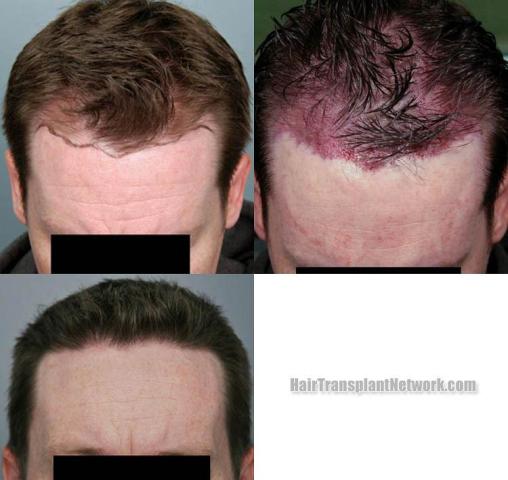 Hair restoration procedure before and after results