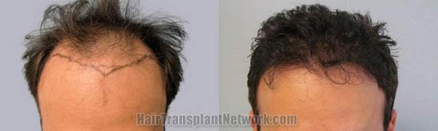 Hair restoration procedure before and after results