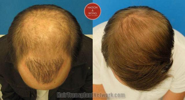 Hair transplantation surgery before and after photos