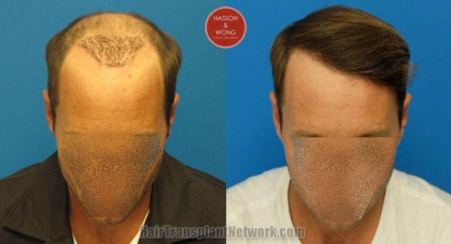 Hair restoration procedure before and after pictures