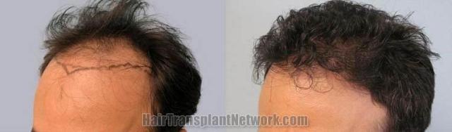 Hair transplantation surgery before and after pictures