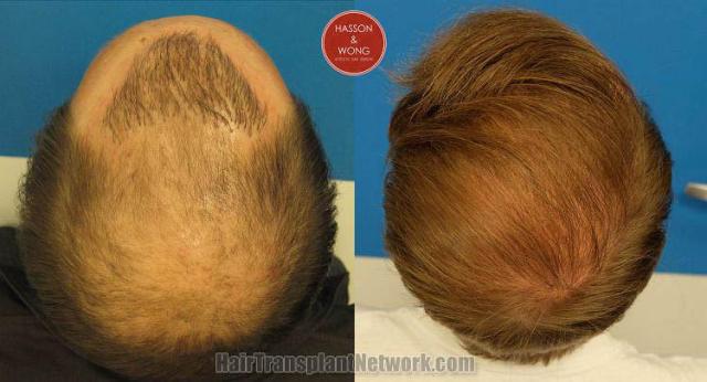 Hair restoration procedure before and after pictures