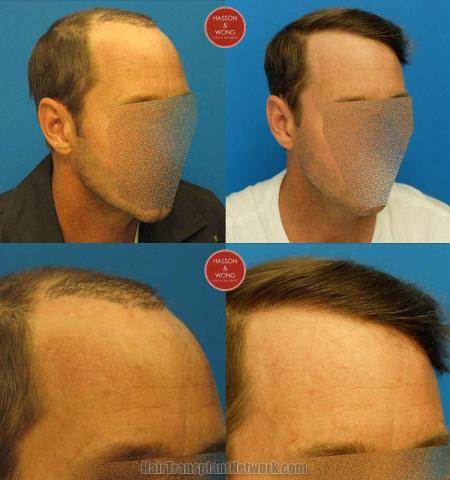 Hair transplantation surgery before and after images