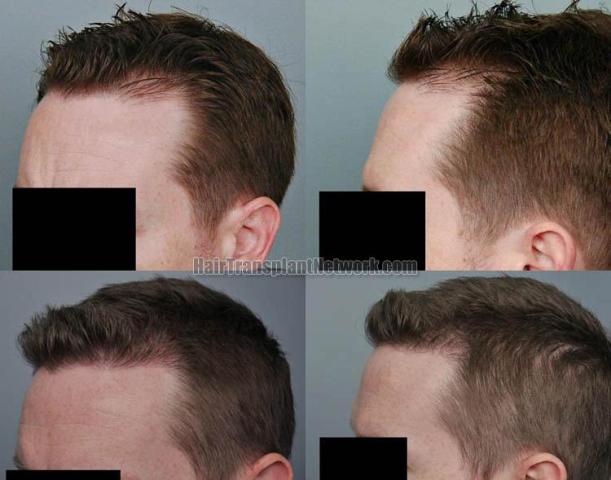 Hair transplantation surgery before and after images