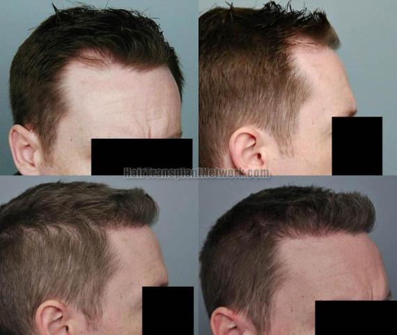 Hair transplantation surgery before and after photos