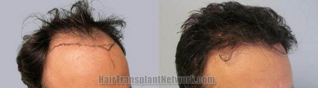 Hair transplantation surgery before and after images