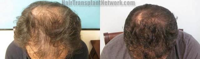 Hair restoration procedure before and after results