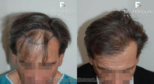 Top view before and after hair restoration results