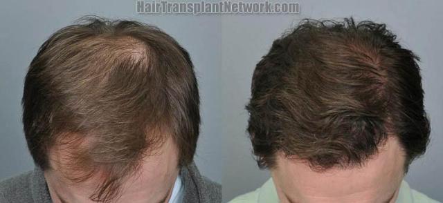 Hair transplantation surgery before and after images