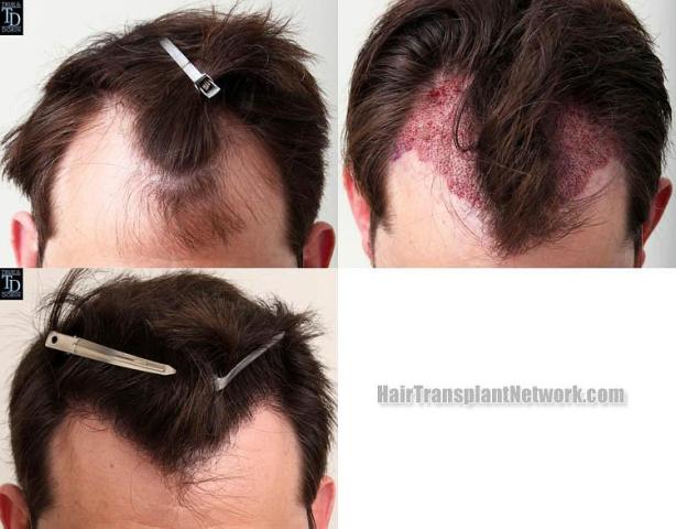 Hair transplantation surgery before and after photos