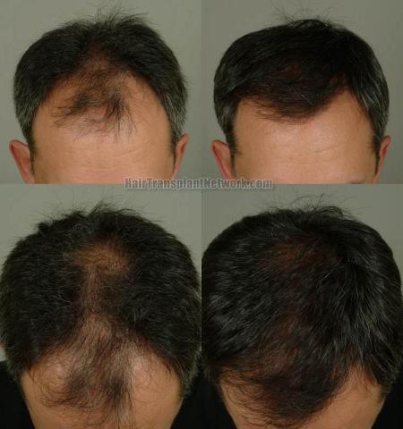 Hair transplantation surgery before and after photos