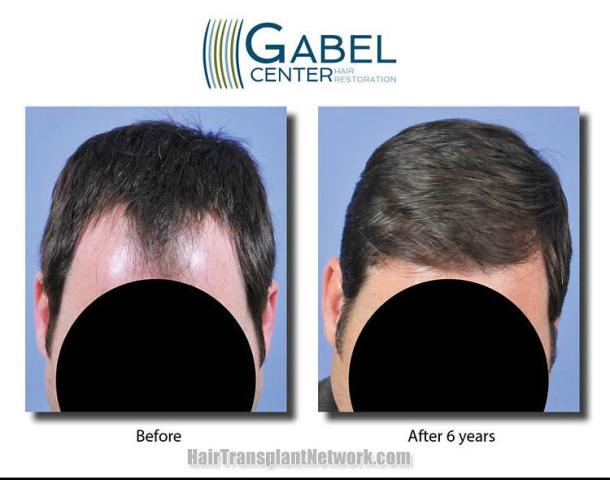 Hair transplantation surgery before and after photos