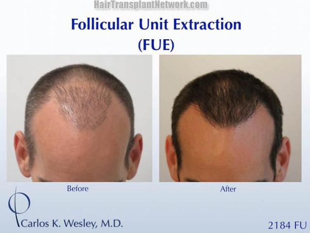 Hair transplantation surgery before and after photos