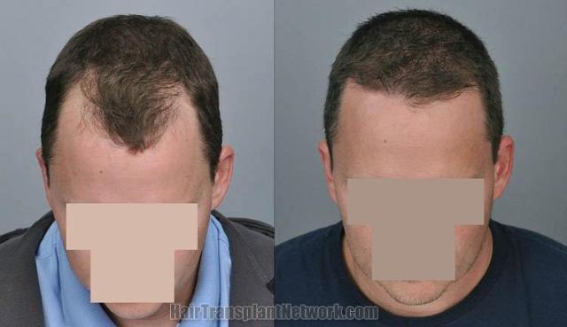 Top view before and after hair restoration results