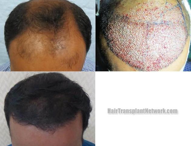 Hair transplantation surgery before and after images