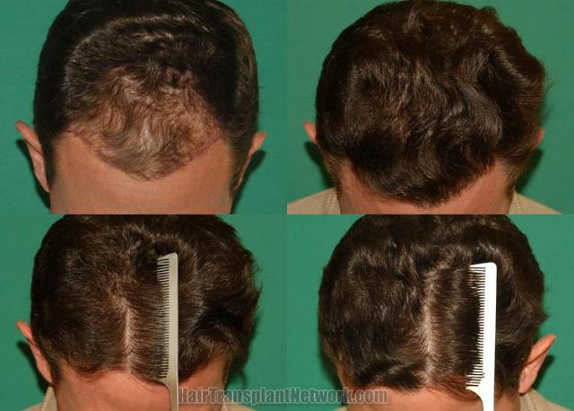 Hair restoration procedure before and after results