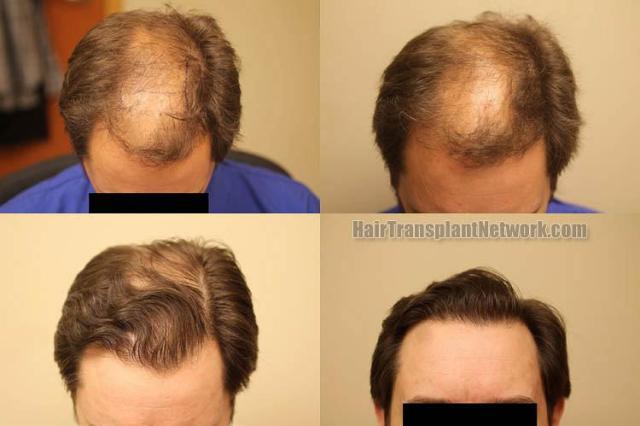 Hair transplantation surgery before and after photos