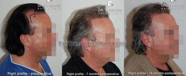 Hair transplantation surgery before and after images