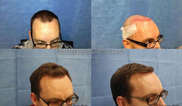 Hair transplantation surgery before and after pictures