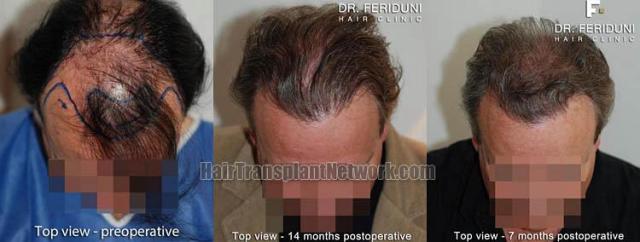 Hair transplantation surgery before and after photos