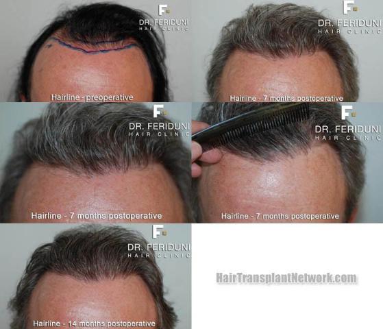 Hair transplant surgery before and after images