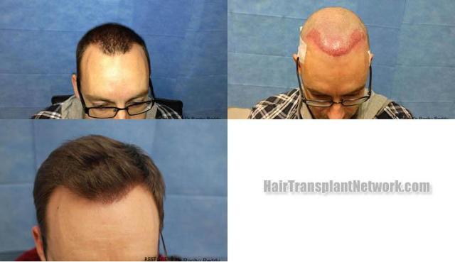 Hair transplantation surgery before and after images