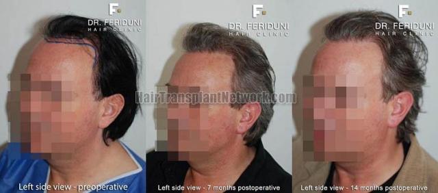 Hair restoration surgery before and after images